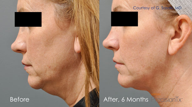 Side views of woman before skin tightening and 6 months after, with a stronger jawline and reduced double chin and neck fat.