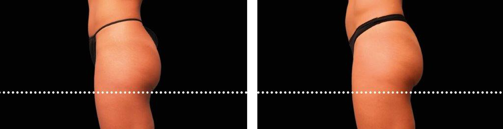 Side view of a woman's hip and buttock before and after EMSCULPT. The after photo shows a rounder, more lifted buttock.
