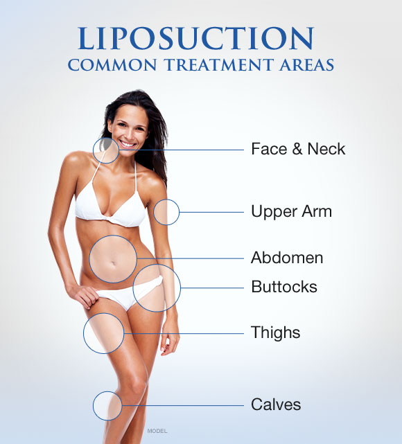 Circles showing common liposuction treatment areas on woman's body: face, neck, upper arm, abdomen, butt, thighs, and calves.