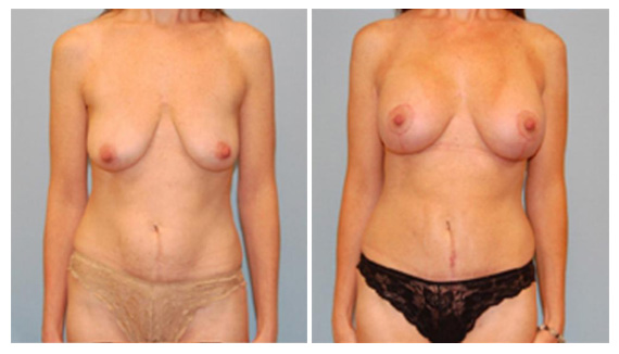 Breast enhancement in Westchester County