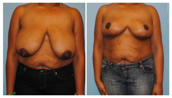 Before & after breast reduction surgery