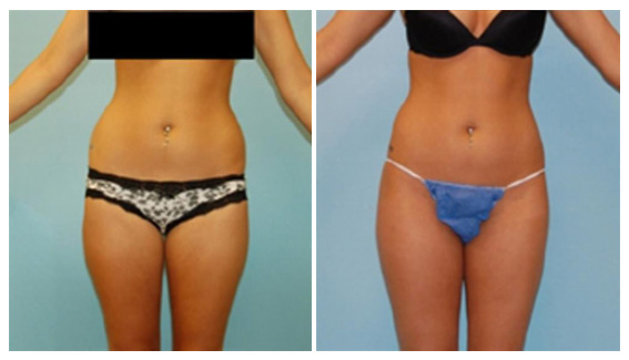 Liposuction fat reduction