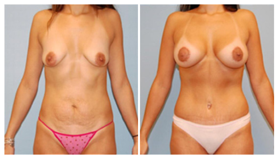 Tummy tuck in Westchester County