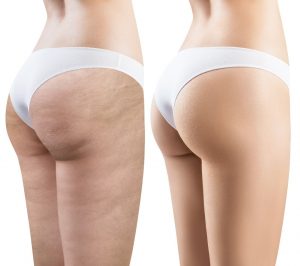 Cellulite treatment in Westchester County, NY