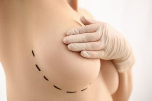 Breast Augmentation near White Plains, NY